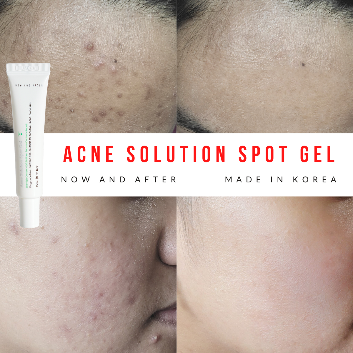 NOW AND AFTER Acne Solution Spot Gel 15ml